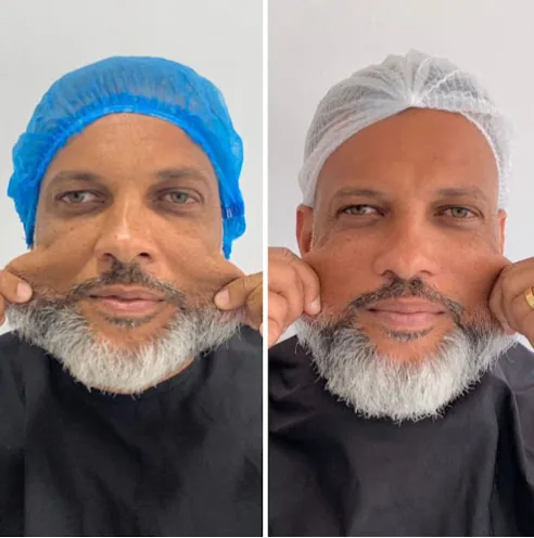 Comparativo facial de paciente após tratamento estético