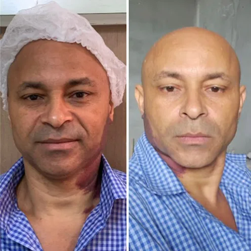Comparativo de contorno facial antes e depois do tratamento