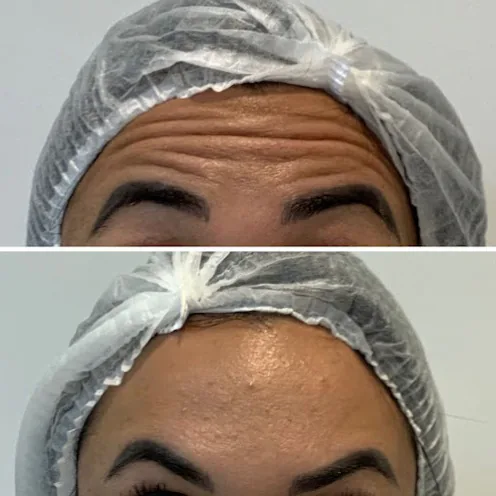 Comparativo da região frontal após tratamento facial