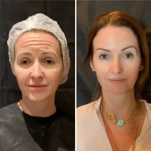 Comparativo facial antes e depois de tratamento personalizado