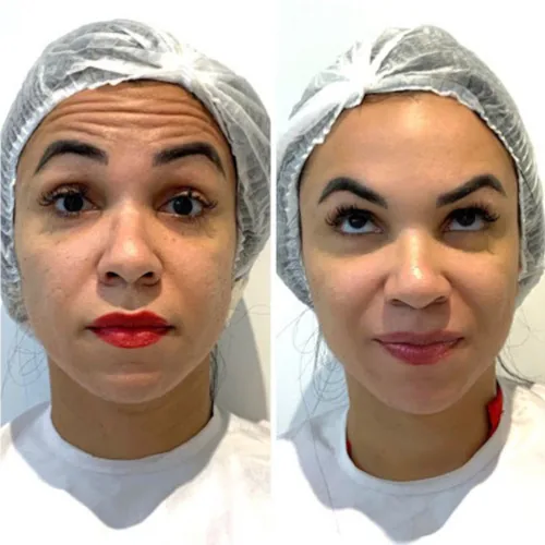 Comparativo facial após tratamento de harmonização