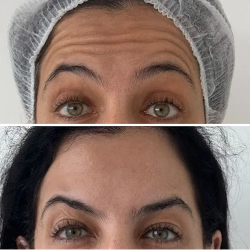 Comparativo da região frontal após tratamento com botox