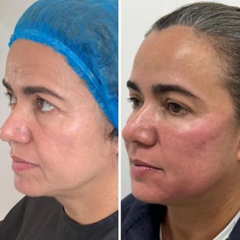 Comparativo facial em tratamento da região das olheiras