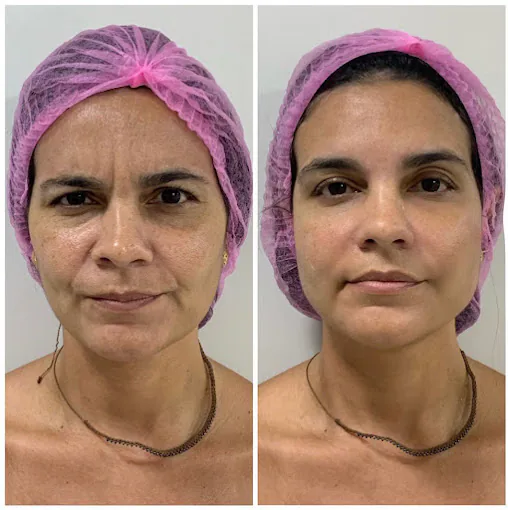 Comparativo facial em tratamento com bioestimulador de colágeno