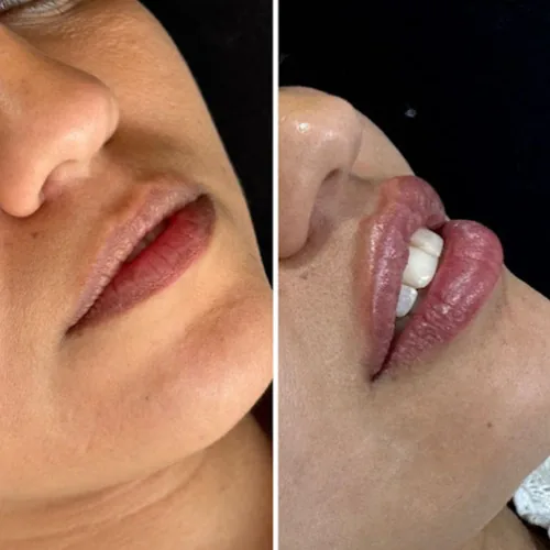 Comparativo de lábios em tratamento de preenchimento labial
