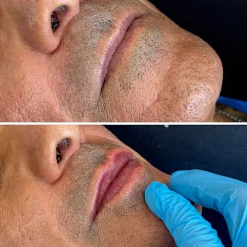 Tratamento facial na região do sulco nasolabial